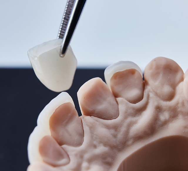 Carefully placing veneer on model of teeth
