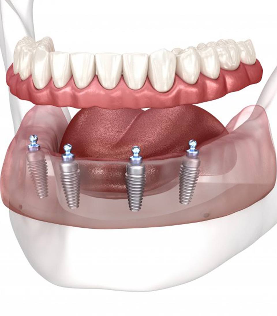 Lady presents viewer with dentures