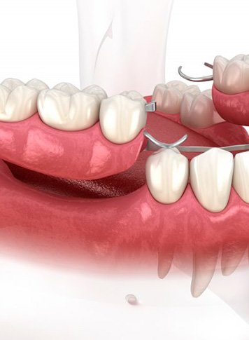 Illustration of partial dentures