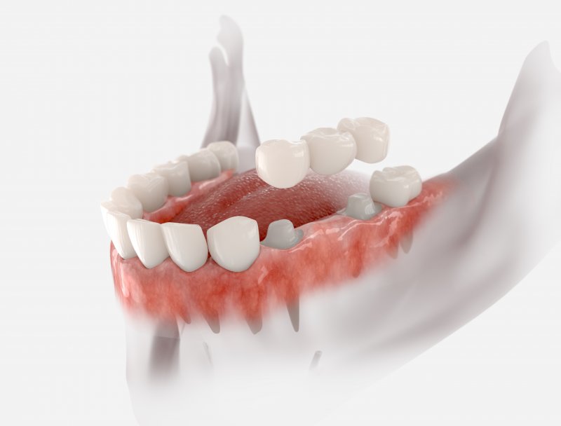 Illustration of dental bridge